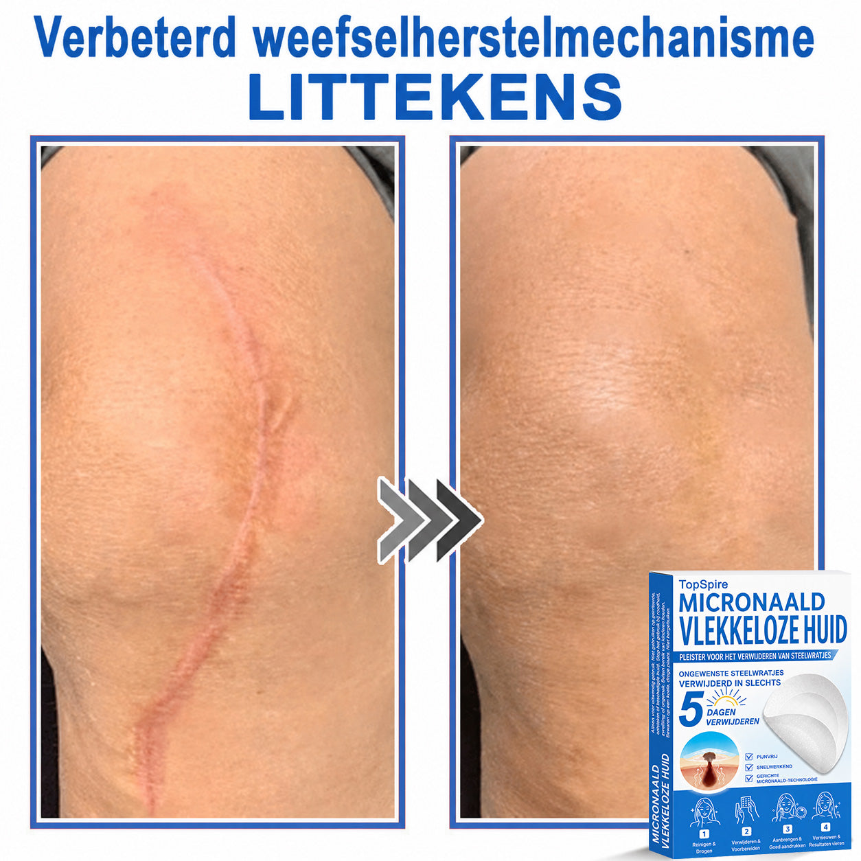 🧑‍⚕️ TopSpire® 2-in-1 micronaald- & hydrocolloïdpleisters | Verwijderaar voor verheven moedervlekken, acne, platte wratten & steelwratjes  Verbetert het uiterlijk van rimpels