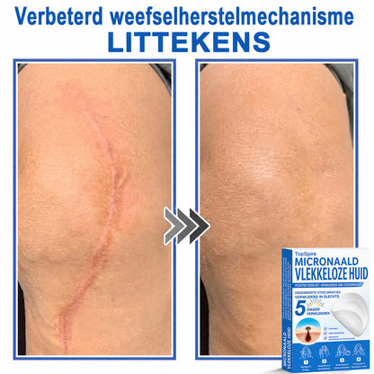 🧑‍⚕️ TopSpire® 2-in-1 micronaald- & hydrocolloïdpleisters | Verwijderaar voor verheven moedervlekken, acne, platte wratten & steelwratjes  Verbetert het uiterlijk van rimpels