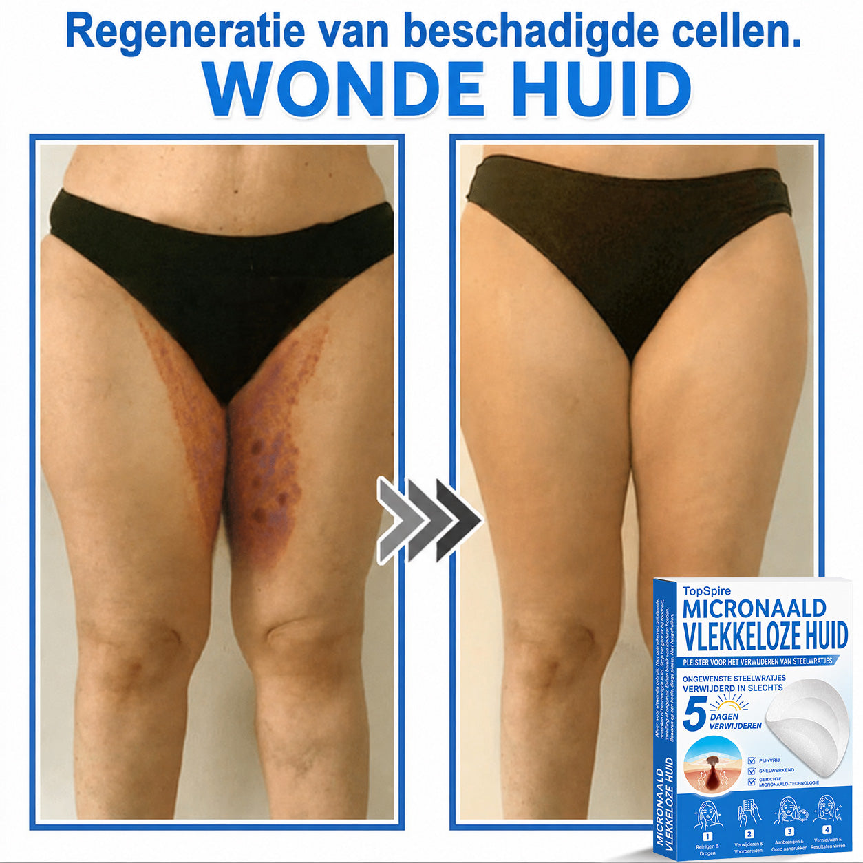 🧑‍⚕️ TopSpire® 2-in-1 micronaald- & hydrocolloïdpleisters | Verwijderaar voor verheven moedervlekken, acne, platte wratten & steelwratjes  Verbetert het uiterlijk van rimpels