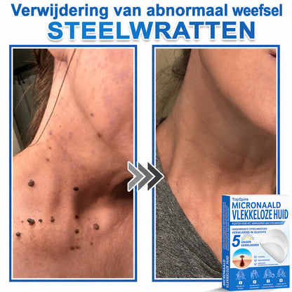 🧑‍⚕️ TopSpire® 2-in-1 micronaald- & hydrocolloïdpleisters | Verwijderaar voor verheven moedervlekken, acne, platte wratten & steelwratjes  Verbetert het uiterlijk van rimpels