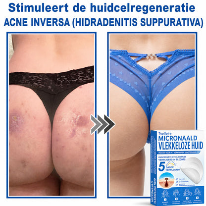 🧑‍⚕️ TopSpire® 2-in-1 micronaald- & hydrocolloïdpleisters | Verwijderaar voor verheven moedervlekken, acne, platte wratten & steelwratjes  Verbetert het uiterlijk van rimpels