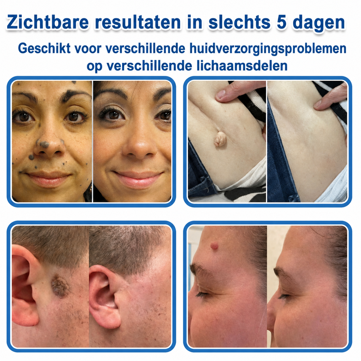 🧑‍⚕️ TopSpire® 2-in-1 micronaald- & hydrocolloïdpleisters | Verwijderaar voor verheven moedervlekken, acne, platte wratten & steelwratjes  Verbetert het uiterlijk van rimpels