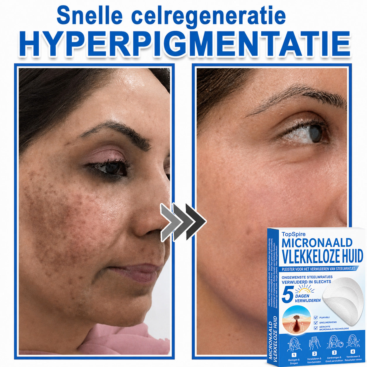 🧑‍⚕️ TopSpire® 2-in-1 micronaald- & hydrocolloïdpleisters | Verwijderaar voor verheven moedervlekken, acne, platte wratten & steelwratjes  Verbetert het uiterlijk van rimpels