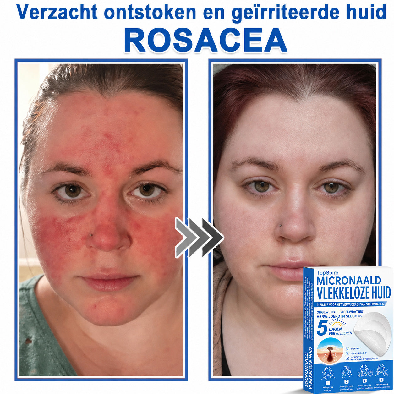 🧑‍⚕️ TopSpire® 2-in-1 micronaald- & hydrocolloïdpleisters | Verwijderaar voor verheven moedervlekken, acne, platte wratten & steelwratjes  Verbetert het uiterlijk van rimpels