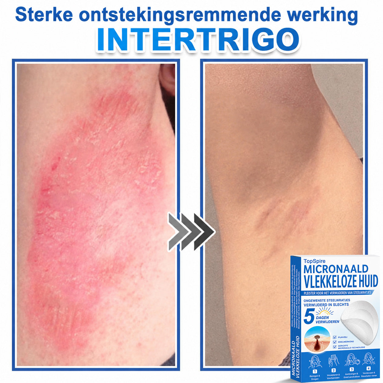🧑‍⚕️ TopSpire® 2-in-1 micronaald- & hydrocolloïdpleisters | Verwijderaar voor verheven moedervlekken, acne, platte wratten & steelwratjes  Verbetert het uiterlijk van rimpels