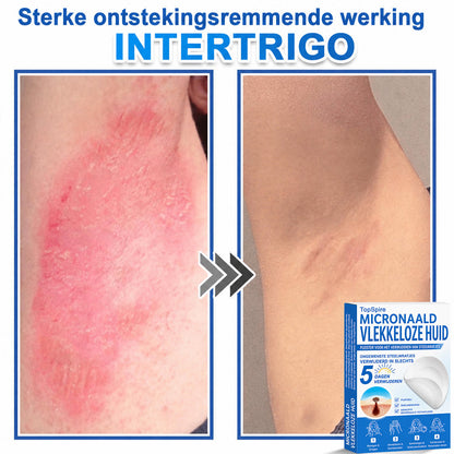 🧑‍⚕️ TopSpire® 2-in-1 micronaald- & hydrocolloïdpleisters | Verwijderaar voor verheven moedervlekken, acne, platte wratten & steelwratjes  Verbetert het uiterlijk van rimpels