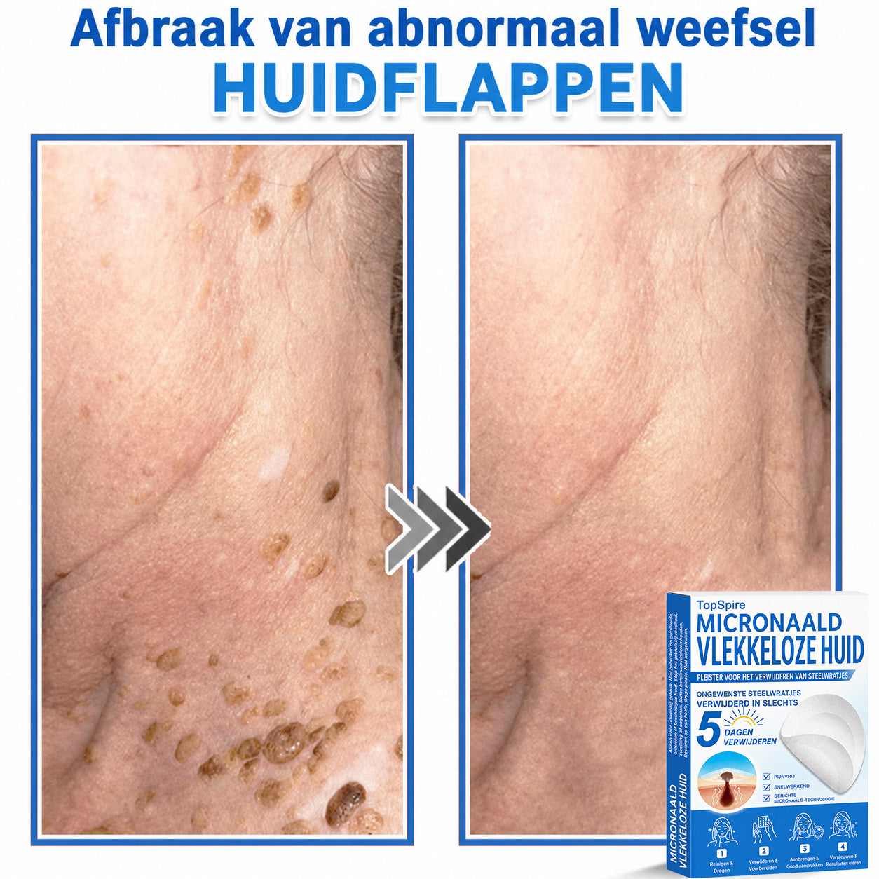 🧑‍⚕️ TopSpire® 2-in-1 micronaald- & hydrocolloïdpleisters | Verwijderaar voor verheven moedervlekken, acne, platte wratten & steelwratjes  Verbetert het uiterlijk van rimpels