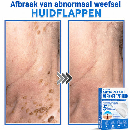 🧑‍⚕️ TopSpire® 2-in-1 micronaald- & hydrocolloïdpleisters | Verwijderaar voor verheven moedervlekken, acne, platte wratten & steelwratjes  Verbetert het uiterlijk van rimpels