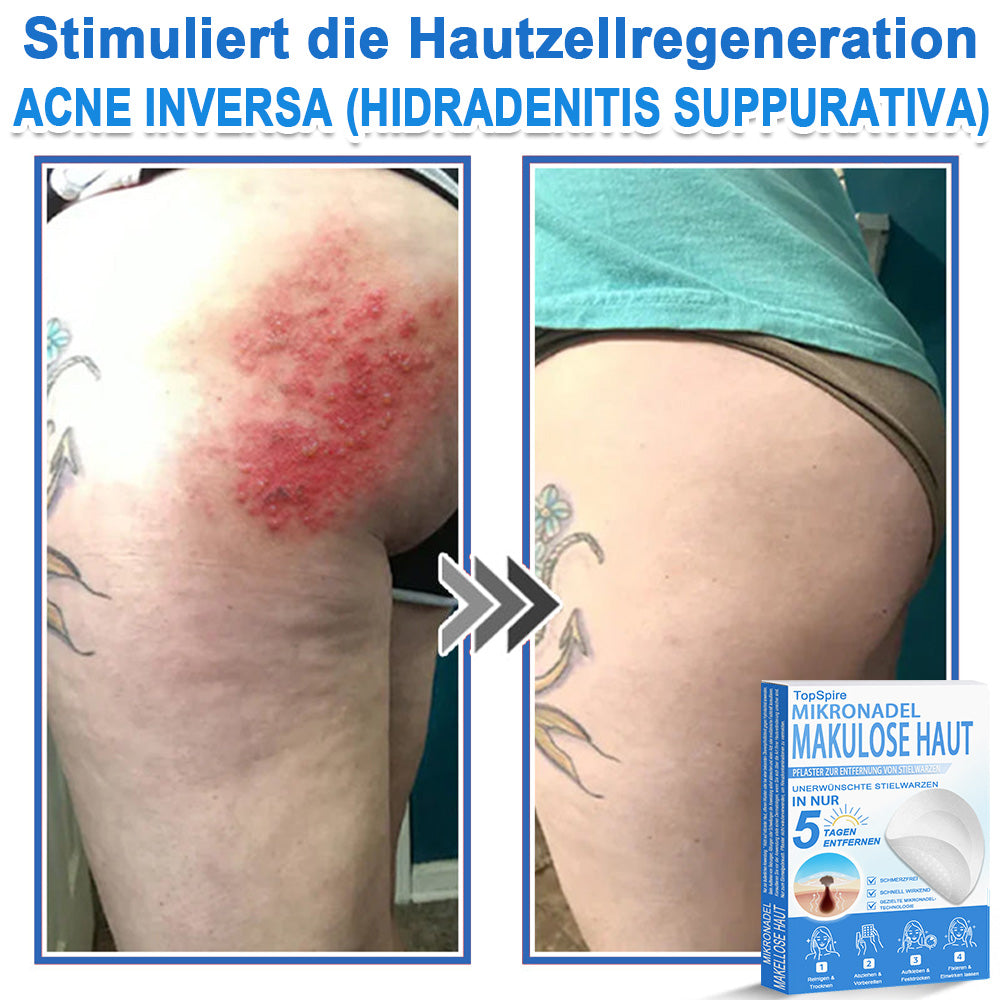 🧑‍⚕️ TopSpire® 2-in-1 micronaald- & hydrocolloïdpleisters | Verwijderaar voor verheven moedervlekken, acne, platte wratten & steelwratjes  Verbetert het uiterlijk van rimpels