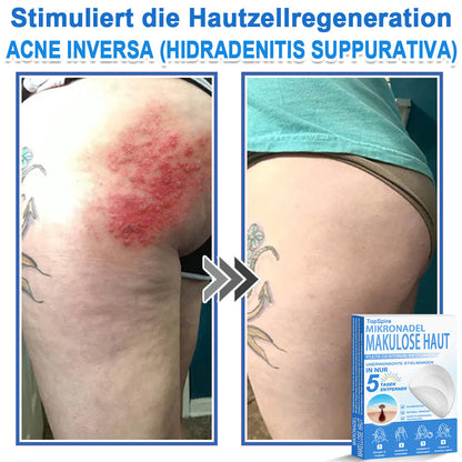 🧑‍⚕️ TopSpire® 2-in-1 micronaald- & hydrocolloïdpleisters | Verwijderaar voor verheven moedervlekken, acne, platte wratten & steelwratjes  Verbetert het uiterlijk van rimpels